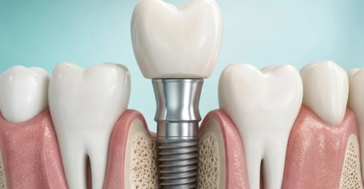 Dental Implant Healing Abutment 2